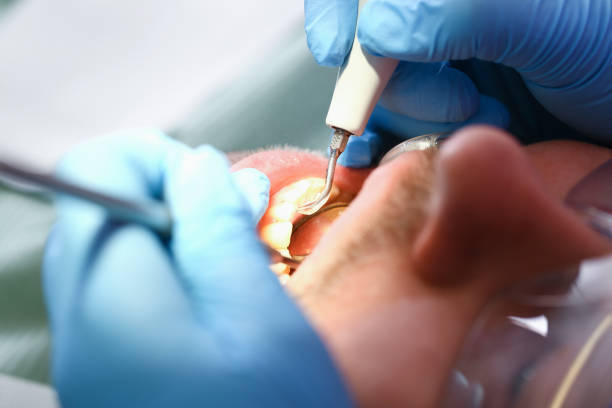 Best Emergency Treatment for Dental Infections or Abscesses in Pampa, TX